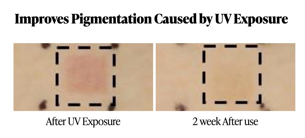 UV-Induced Pigmentation